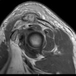 Septic Arthritis of AC Joint. MRI Sagittal. Unannotated. JETem 2024