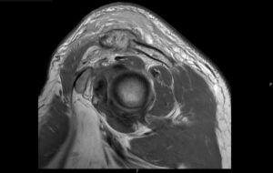 Septic Arthritis of AC Joint. MRI Sagittal. Unannotated. JETem 2024