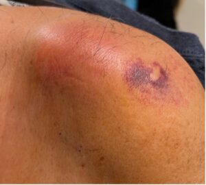 Septic Arthritis of AC Joint. Shoulder Photo Close. JETem 2024