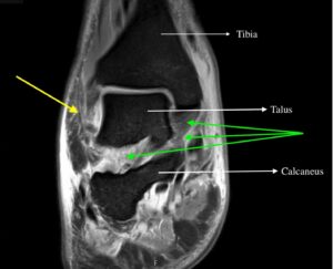 Septic Arthritis. Ankle MRI Coronal. Annotated. JETem 2024