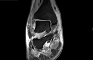 Septic Arthritis. Ankle MRI Coronal. Unannotated. JETem 2024
