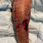 Acute Compartment Syndrome. Photo Post Fasciotomy. JETem 2024
