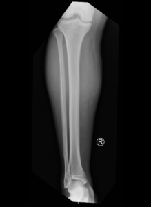 Acute Compartment Syndrome. XRay. JETem 2024