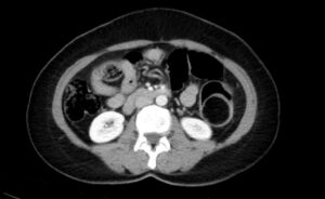 Adult Intussusception. CT Axial Unannotated. JETem 2024