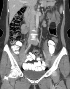 Adult Intussusception. CT Coronal Unannotated. JETem 2024