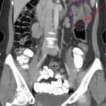 Adult Intussusception. CT Coronal annotated. JETem 2024