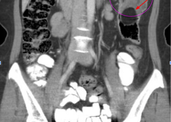 Adult Intussusception. CT Coronal annotated. JETem 2024
