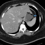 Gastric Emphysema. Axial CT annotated. JETem 2024