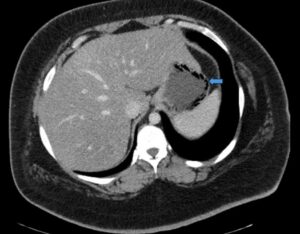 Gastric Emphysema. Axial CT annotated. JETem 2024