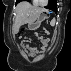 Gastric Emphysema. Coronal CT annotated. JETem 2024