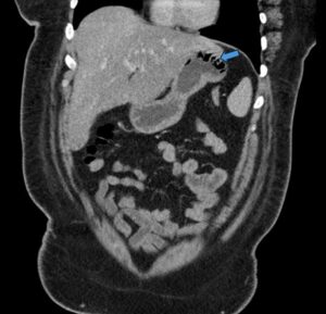 Gastric Emphysema. Coronal CT annotated. JETem 2024