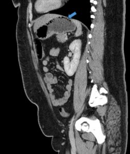 Gastric Emphysema. Sagital CT annotated. JETem 2024