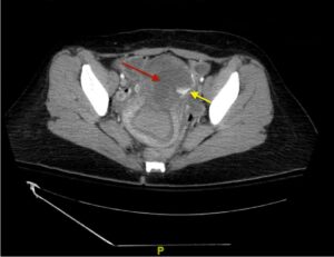 Iatrogenic Uterine Perforation. CT Annotated. JETem 2024
