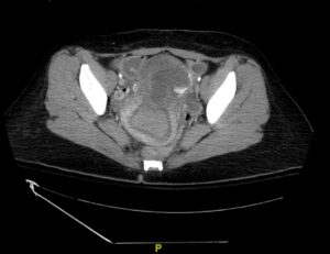 Iatrogenic Uterine Perforation. CT Unannotated. JETem 2024
