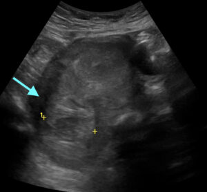 Iatrogenic Uterine Perforation. US Annotated. JETem 2024
