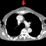 Chest wall abscess CT axial annotated. JETem 2024