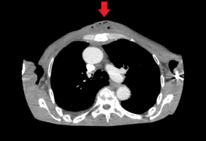 Chest wall abscess CT axial annotated. JETem 2024