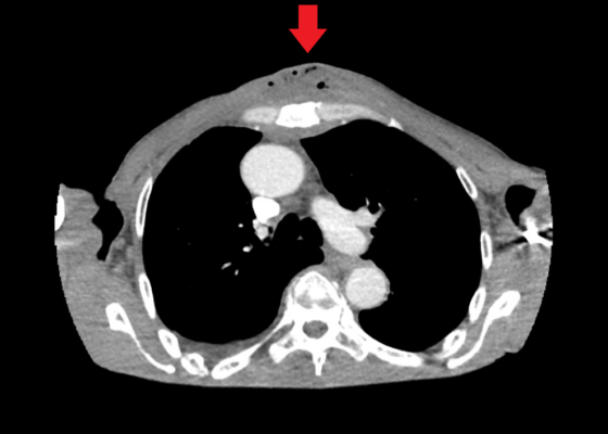 Chest wall abscess CT axial annotated. JETem 2024