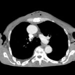 Chest wall abscess CT axial unannotated. JETem 2024