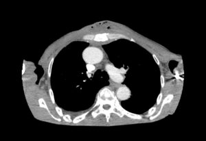 Chest wall abscess CT axial unannotated. JETem 2024