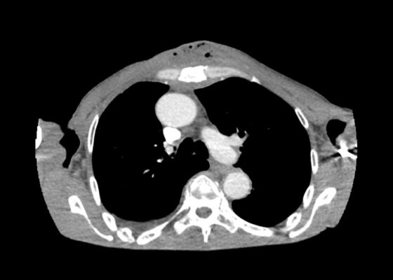 Chest wall abscess CT axial unannotated. JETem 2024