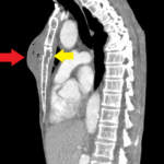 Chest wall abscess CT sagittal annotated. JETem 2024