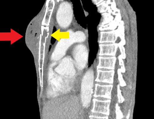 Chest wall abscess CT sagittal annotated. JETem 2024