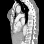 Chest wall abscess CT sagittal unannotated. JETem 2024