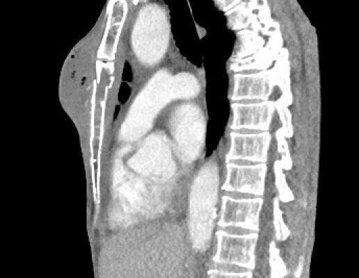 Chest wall abscess CT sagittal unannotated. JETem 2024