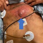 Chest wall abscess. Photograph annotated. JETem 2024