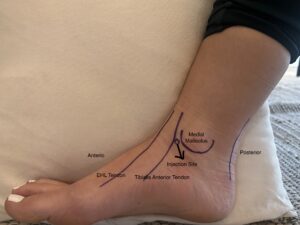 Subtalar Dislocation. Personal Injection. JETem 2024