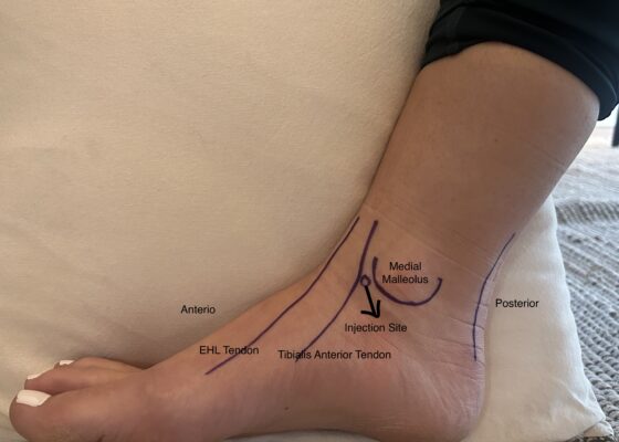 Subtalar Dislocation. Personal Injection. JETem 2024