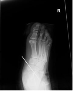 Subtalar Dislocation. Post surgical reduction AP. JETem 2024