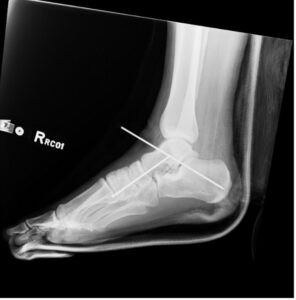 Subtalar Dislocation. Post surgical reduction lateral. JETem 2024