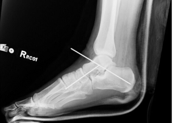 Subtalar Dislocation. Post surgical reduction lateral. JETem 2024