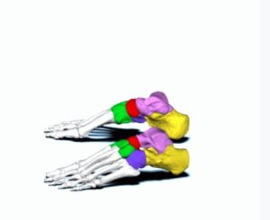 Subtalar Dislocation. Subtalar Dislocation. Bones JPEG. JETem 2024