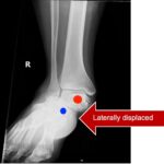 Subtalar Dislocation. Subtalar dislocation AP annotated. JETem 2024