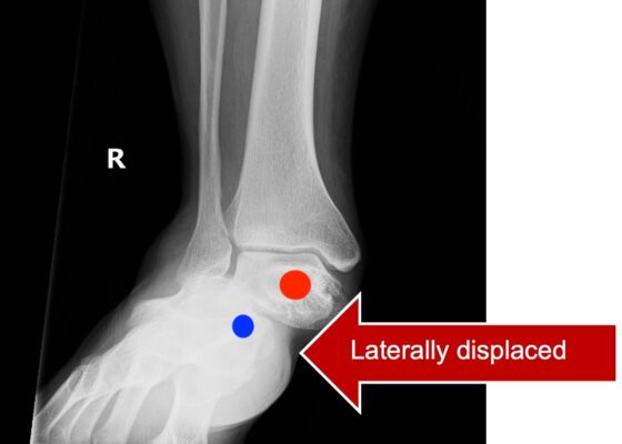 Subtalar Dislocation. Subtalar dislocation AP annotated. JETem 2024