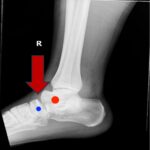 Subtalar Dislocation. Subtalar dislocation lateral annotated. JETem 2024