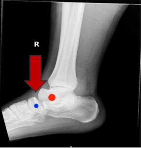 Subtalar Dislocation. Subtalar dislocation lateral annotated. JETem 2024