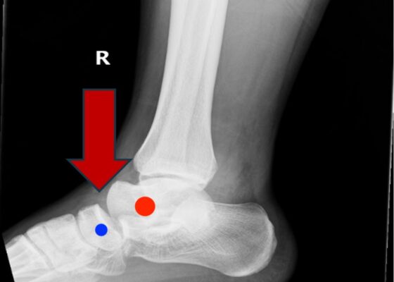 Subtalar Dislocation. Subtalar dislocation lateral annotated. JETem 2024