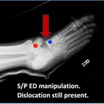 Subtalar Dislocation. sp manipulation annotated. JETem 2024