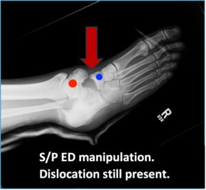 Subtalar Dislocation. sp manipulation annotated. JETem 2024
