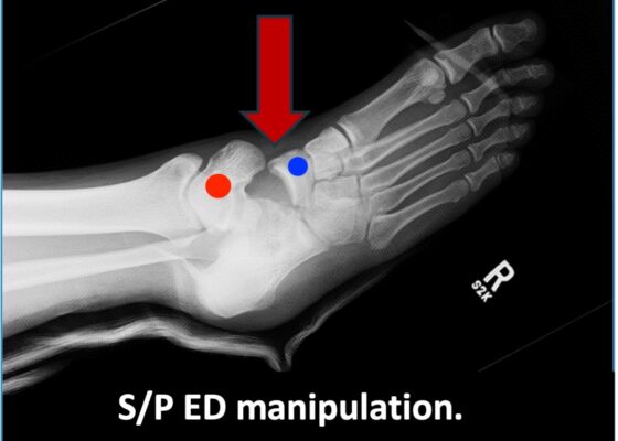 Subtalar Dislocation. sp manipulation annotated. JETem 2024