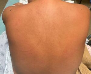 Dermatomyositis Back. JETem 2024