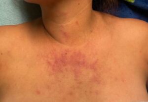 Dermatomyositis Chest. JETem 2024