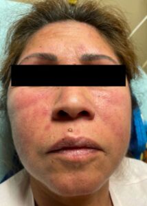 Dermatomyositis Face. JETem 2024