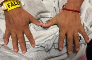 Dermatomyositis Hands. JETem 2024