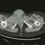 Vulvar Hematoma. CT Axial Annotated. JETem 2024