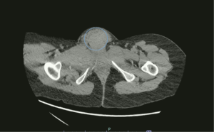 Vulvar Hematoma. CT Axial Annotated. JETem 2024